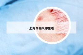 上海白癜風(fēng)哪里看