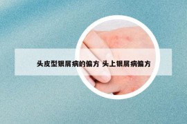 頭皮型銀屑病的偏方 頭上銀屑病偏方