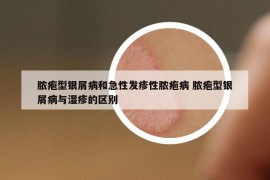 膿皰型銀屑病和急性發(fā)疹性膿皰病 膿皰型銀屑病與濕疹的區(qū)別