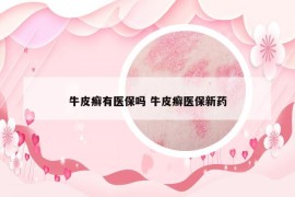 牛皮癬有醫(yī)保嗎 牛皮癬醫(yī)保新藥