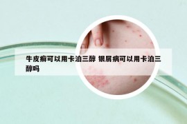 牛皮癬可以用卡泊三醇 銀屑病可以用卡泊三醇嗎