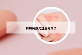 白癜風(fēng)激光過后更白了