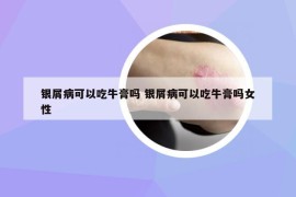 銀屑病可以吃牛膏嗎 銀屑病可以吃牛膏嗎女性