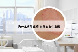 為什么有牛皮癬 為什么會牛皮廨