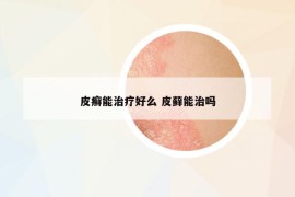 皮癬能治療好么 皮蘚能治嗎