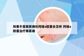 如果不是銀屑病吃阿維a膠囊會怎樣 阿維a膠囊治療銀屑病
