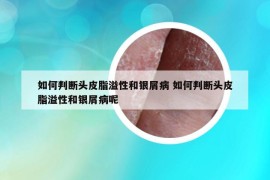 如何判斷頭皮脂溢性和銀屑病 如何判斷頭皮脂溢性和銀屑病呢