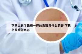 下巴上長(zhǎng)了像癬一樣的東西用什么藥膏 下巴上長(zhǎng)癬怎么辦