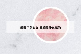 起蘚了怎么辦 起癬是什么樣的