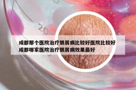 成都那個醫(yī)院治療銀屑病比較好醫(yī)院比較好 成都哪家醫(yī)院治療銀屑病效果最好