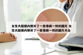 女生大腿根內(nèi)側(cè)長(zhǎng)了一些像癬一樣的圖片 女生大腿根內(nèi)側(cè)長(zhǎng)了一些像癬一樣的圖片大全