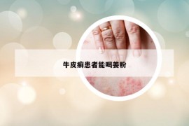 牛皮癬患者能喝姜粉