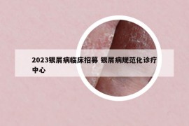 2023銀屑病臨床招募 銀屑病規(guī)范化診療中心