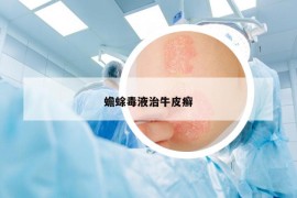 蟾蜍毒液治牛皮癬