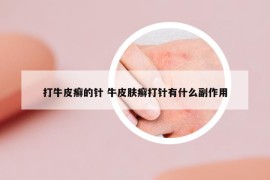 打牛皮癬的針 牛皮膚癬打針有什么副作用
