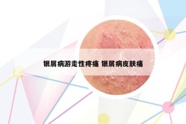 銀屑病游走性疼痛 銀屑病皮膚痛