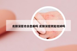 皮膚深層也會(huì)患癬嗎 皮膚深層斑能祛掉嗎