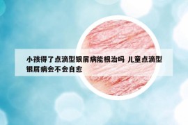 小孩得了點滴型銀屑病能根治嗎 兒童點滴型銀屑病會不會自愈