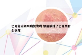 巴克能治銀屑病復(fù)發(fā)嗎 銀屑病抹了巴克為什么很癢