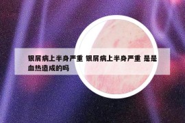 銀屑病上半身嚴重 銀屑病上半身嚴重 是是血熱造成的嗎