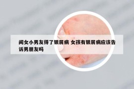 閨女小男友得了銀屑病 女孩有銀屑病應(yīng)該告訴男朋友嗎