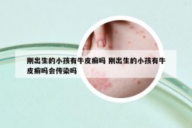 剛出生的小孩有牛皮癬嗎 剛出生的小孩有牛皮癬嗎會傳染嗎