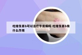 吃維生素b可以治療牛皮癬嗎 吃維生素b有什么作用