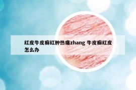 紅皮牛皮癬紅腫熱痛zhang 牛皮癬紅皮怎么辦