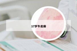 17歲牛皮癬