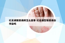 紅皮病銀屑病疼怎么回事 紅皮病型銀屑病會傳染嗎