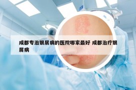 成都專治銀屑病的醫(yī)院哪家最好 成都治療銀屑病