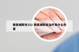 銀屑病照光311 銀屑病照光治療有什么傷害