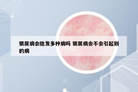 銀屑病會(huì)隱發(fā)多種病嗎 銀屑病會(huì)不會(huì)引起別的病