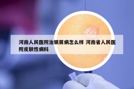 河南人民醫(yī)院治銀屑病怎么樣 河南省人民醫(yī)院皮膚性病科