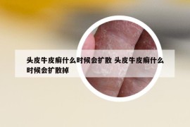 頭皮牛皮癬什么時(shí)候會(huì)擴(kuò)散 頭皮牛皮癬什么時(shí)候會(huì)擴(kuò)散掉