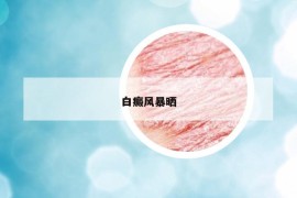白癜風(fēng)暴曬