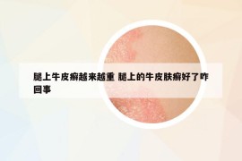 腿上牛皮癬越來(lái)越重 腿上的牛皮膚癬好了咋回事