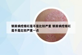 銀屑病疙瘩紅是不是比較嚴重 銀屑病疙瘩紅是不是比較嚴重一點