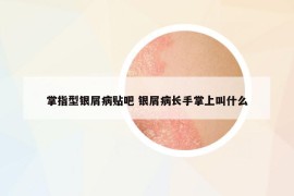 掌指型銀屑病貼吧 銀屑病長(zhǎng)手掌上叫什么