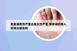 銀屑病男性嚴重還是女性嚴重 銀屑病的男人好找女朋友嗎