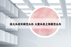 幼兒頭皮長(zhǎng)癬怎么辦 兒童頭皮上有癬怎么辦