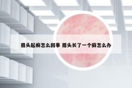 眉頭起癬怎么回事 眉頭長(zhǎng)了一個(gè)蘚怎么辦