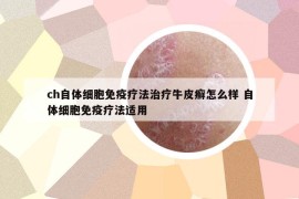 ch自體細(xì)胞免疫療法治療牛皮癬怎么樣 自體細(xì)胞免疫療法適用