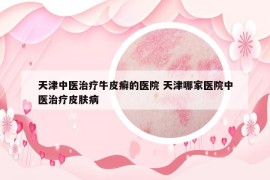 天津中醫(yī)治療牛皮癬的醫(yī)院 天津哪家醫(yī)院中醫(yī)治療皮膚病