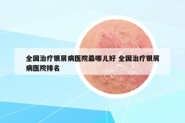全國治療銀屑病醫(yī)院最哪兒好 全國治療銀屑病醫(yī)院排名