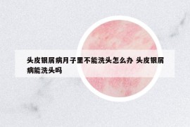 頭皮銀屑病月子里不能洗頭怎么辦 頭皮銀屑病能洗頭嗎
