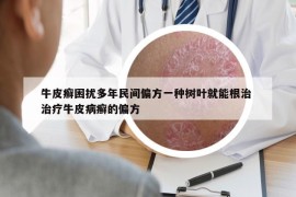 牛皮癬困擾多年民間偏方一種樹(shù)葉就能根治 治療牛皮病癬的偏方