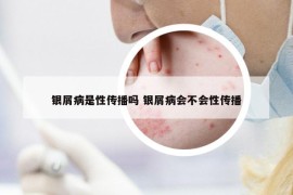 銀屑病是性傳播嗎 銀屑病會不會性傳播