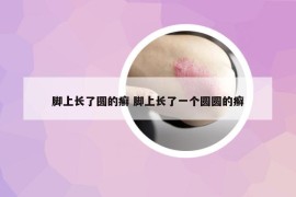 腳上長了圓的癬 腳上長了一個圓圓的癬