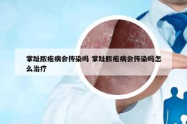 掌趾膿皰病會(huì)傳染嗎 掌趾膿皰病會(huì)傳染嗎怎么治療